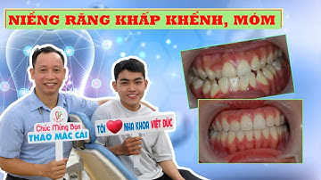 Niềng Răng Điều Trị  Khớp Cắn Ngược/Móm, Răng Khấp Khểnh