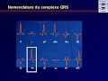 Lecture dun ecg cardiaque normal lectrocardiogramme comment placer les electrodes