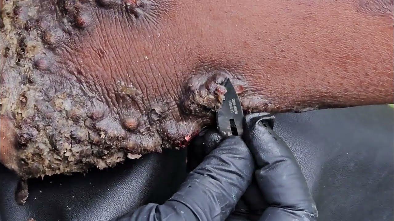 Gideon right foot 2, SO MANY JIGGERS watch long video riseupsociety