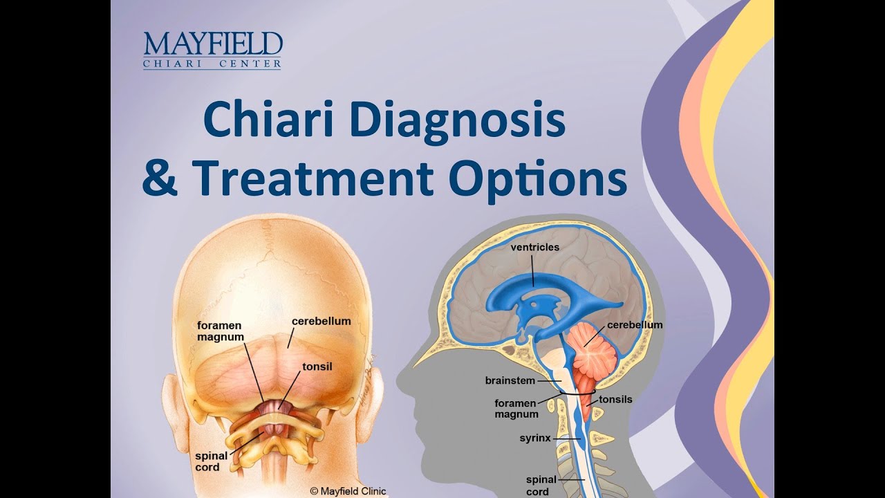 Chiari Malformation Diagnosis & Treatment Options - YouTube