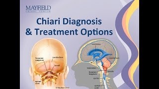 Chiari Malformation Diagnosis & Treatment Options