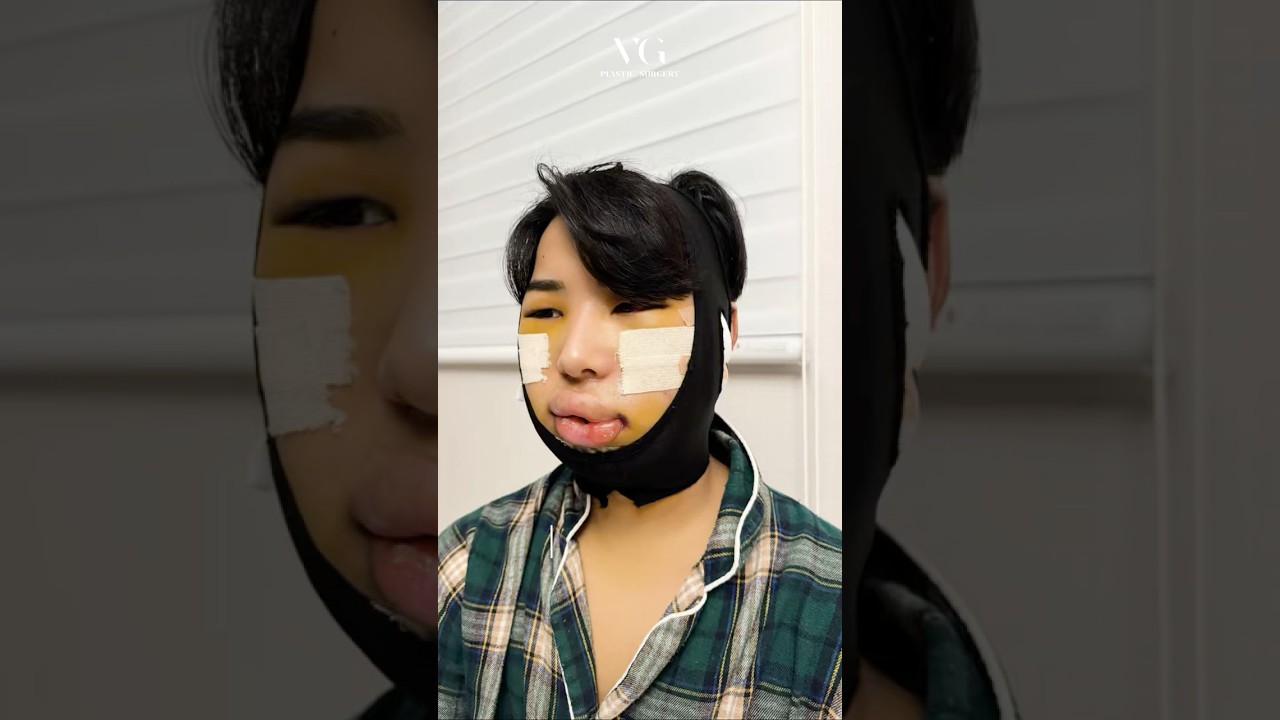 [베리굿성형외과의원] 我變帥了。