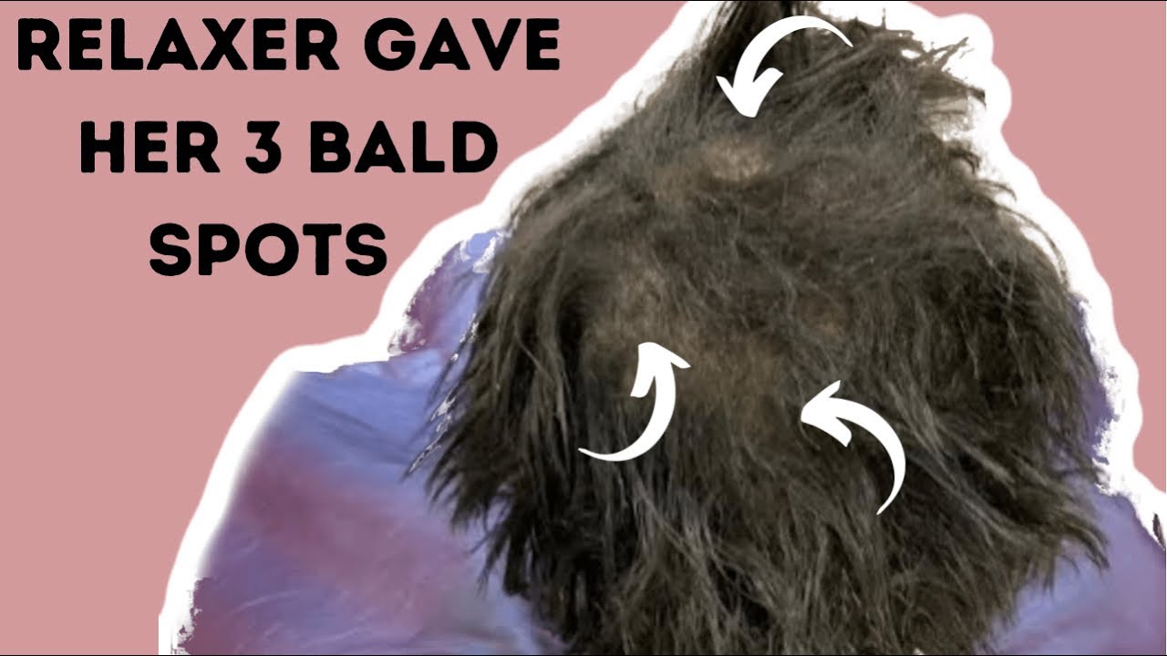 She Got 3 Bald Spots From A Box Perm What To Do When Relaxer Burns she-got-3-bald-spots-from-a-box-perm-what-to-do-when-relaxer-burns