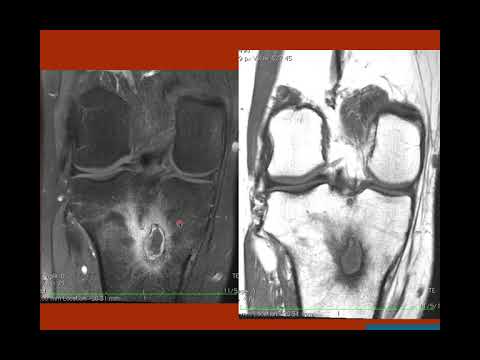 Video: Bilateral Tibial Brodies Abscess Hos En Ung Patient Behandlet Med BAG-S53P4: Case Report
