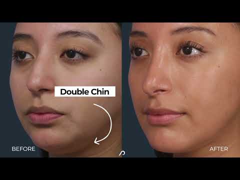 Video thumbnail: BEFORE & AFTER - Rhinoplasty and Chin Augmentation · Dr. David Stoker
