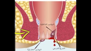 العلاج النهائي والمضمون بارخس الاثمان