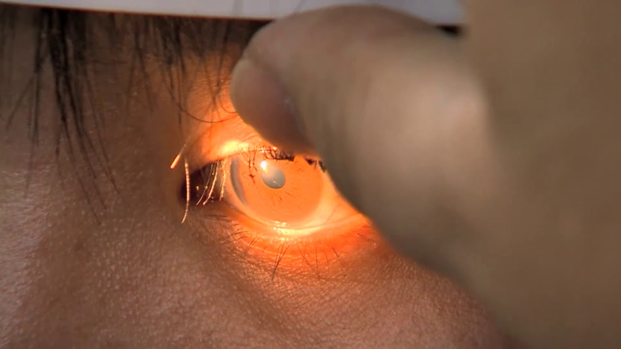 Doctors In Taiwan Found Four Tiny Bees Living Under A Woman s Eyelid 