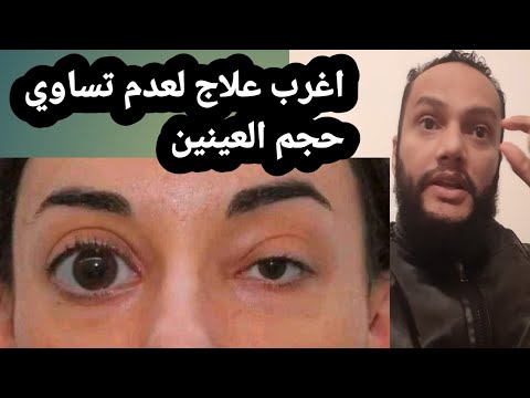 علاج : عدم تساوي حجم العينين بحيت تصبح عين اكبر من عين ؟