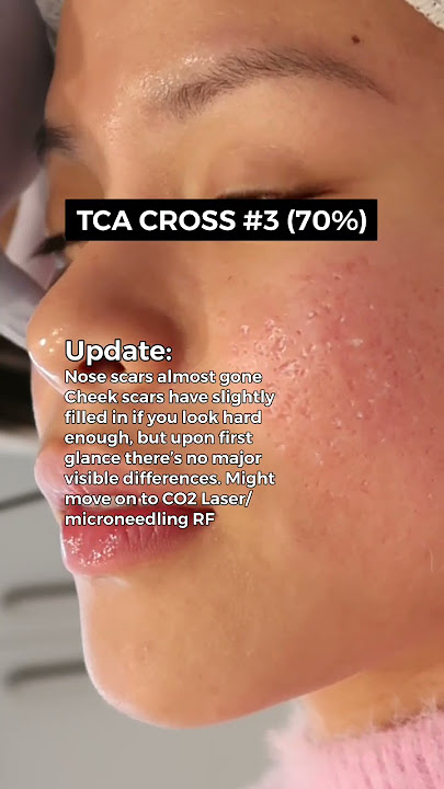 TCA CROSS #3