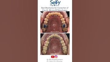 Class II Division II Malocclusion Correction With Lingual Mechanics. #lingualbraces