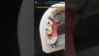 custom abutment and zirconia bridge with screw retained.#dental #china #dentalprosthesis