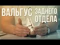 Почему Важно Исправлять ВАЛЬГУС СТОПЫ и Откуда Он Берется