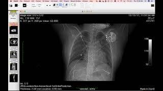 STR Cardiothoracic Case Webinar 4/12/2018