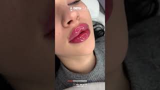 Lips Filler Injection In Best Clinic Turkey