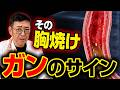 【放置厳禁】胸焼け・酸っぱいげっぷは食道がんへの 危険サイン!逆流性食道炎を根本から治す4つの最新医学アプローチ