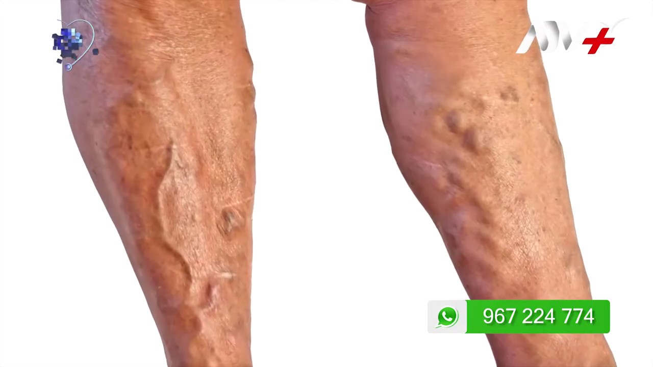 VARICENTRO / COMPLICACIONES DE LAS VARICES