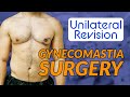 Unilateral Revision Surgery Gynecomastia with Dr Dadvand