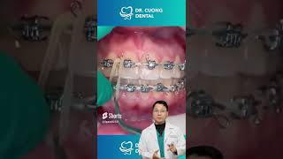 Bạn đang buộc loại chun nào trong niềng răng |Dr Cường Official