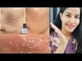 Tca cross 80       remove old acne scars  all details part1