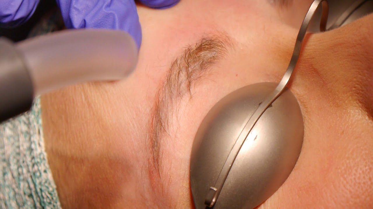Microblading-Entfernung mit dem Laser