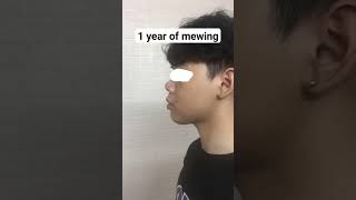 1 year of mewing!