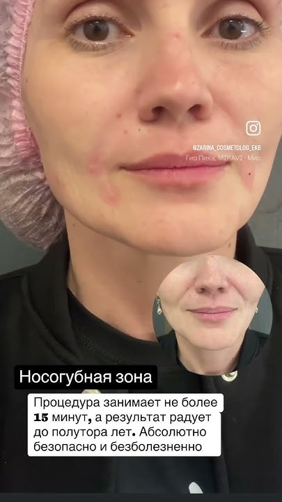 Носогубка филлер носогубная складка гиалуронка - YouTube