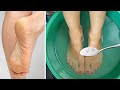 Get Rid of CRACKED HEELS Permanently - Magical Home Remedy