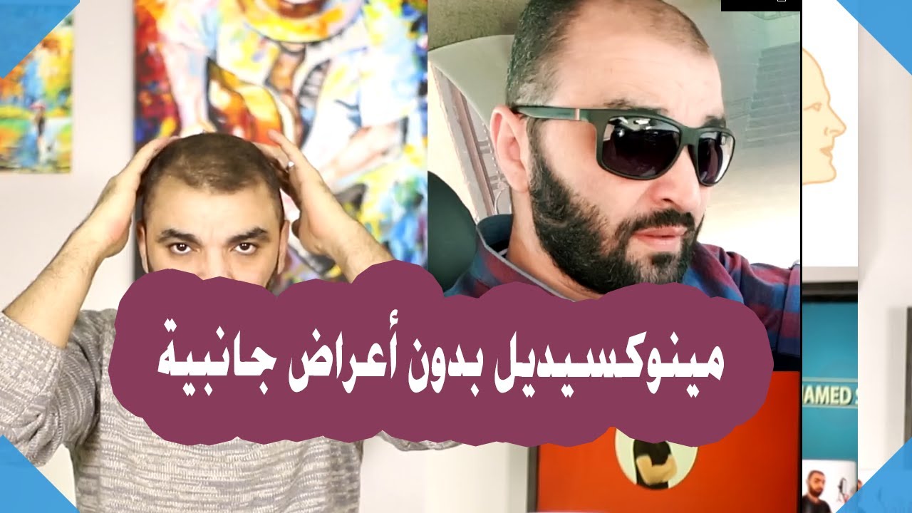 اعراض المينوكسيديل الجانبية  وعلاجها ومراحل نمو الشعر بالمينوكسيديل