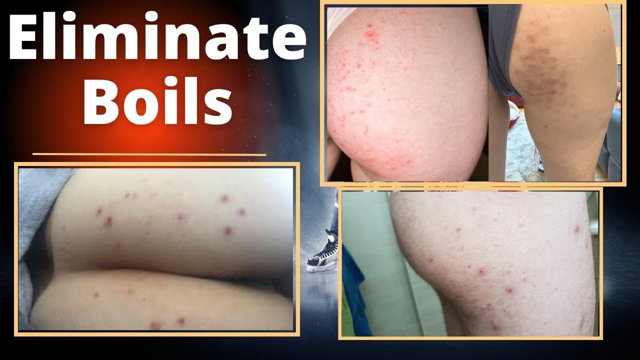 The Secret To Get Rid of Boils | How to TREAT a BOIL on Your BUTTOCKS