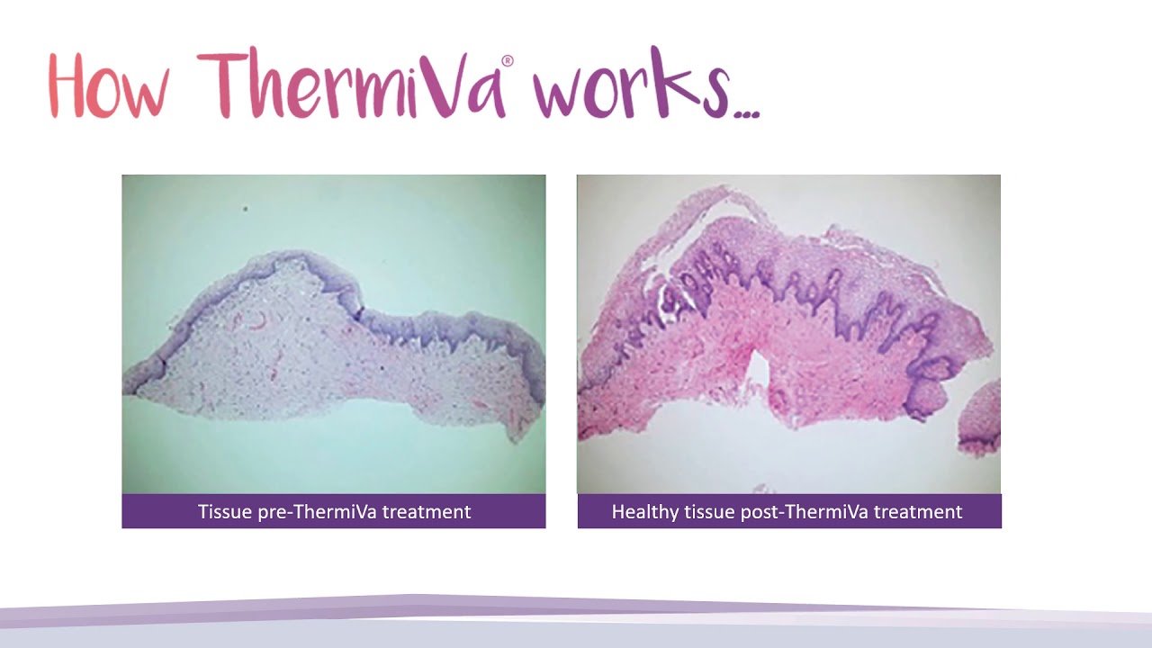 ThermiVa: Celebrate Your Intimacy