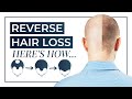 How To Reverse Hair Loss | Treatment, DHT Blocking Shampoo, Medication