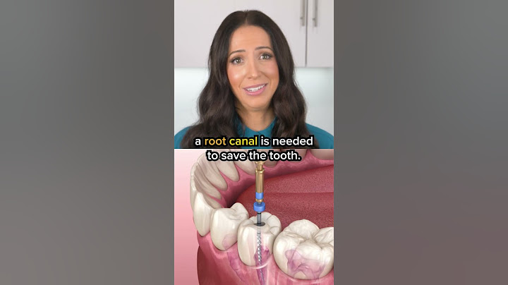 cavities can turn into root canals?! #shorts