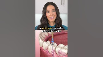 cavities can turn into root canals?! #shorts