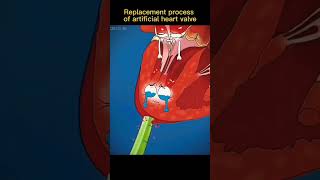 process of artificial heart