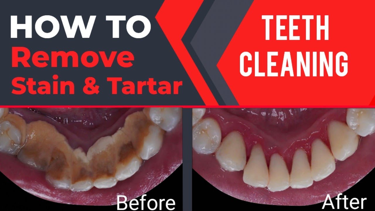 Heavy Tartar cleaning Tartar, Stain Removal by doctor Professional