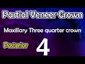 crown|partial veneer crown (three quarter crown for posterior teeth)4