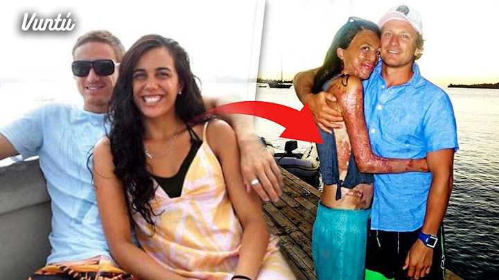 Sufrió quemaduras y su novio NUNCA la dejó. Años después le revela algo escalofriante y…