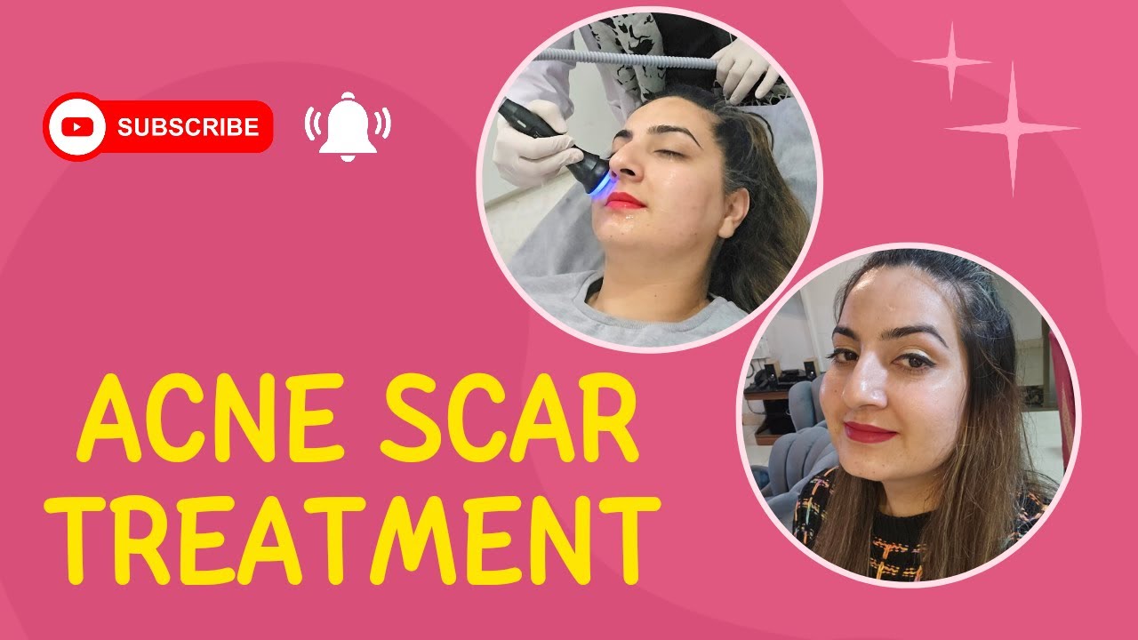 Skin care Acne scar treatment YouTube