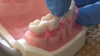 Exploring #30 mesial
