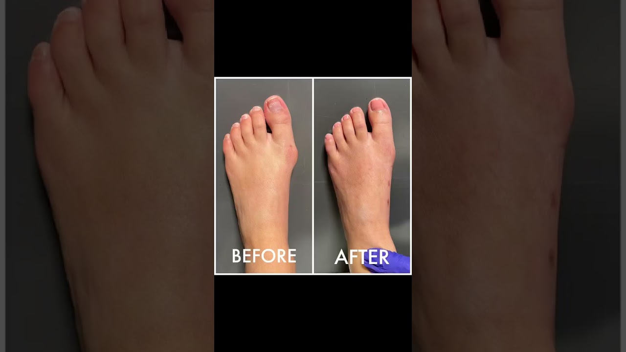 Collection Of Bunion Transformations 