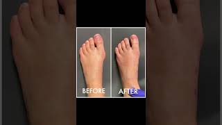 Collection Of Bunion Transformations #Shorts