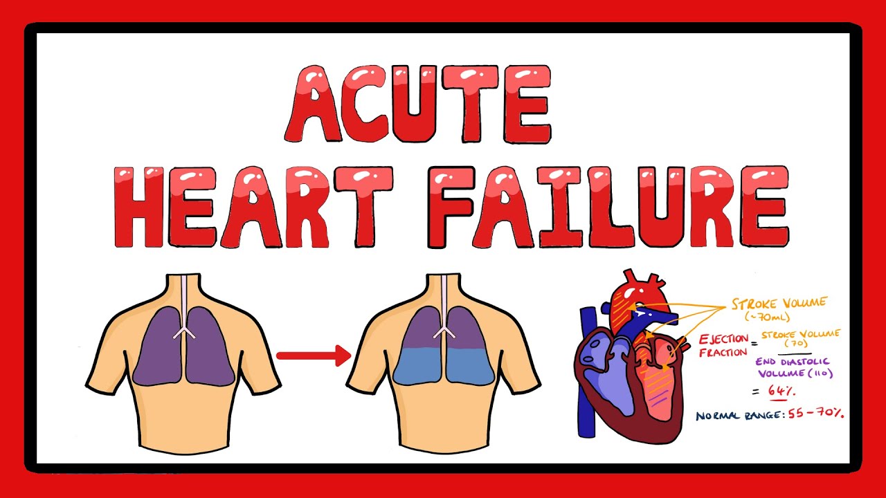 essay on acute heart failure