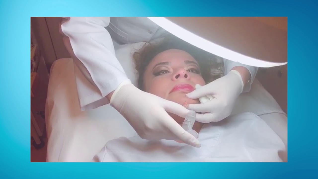 Perfiloplastía facial