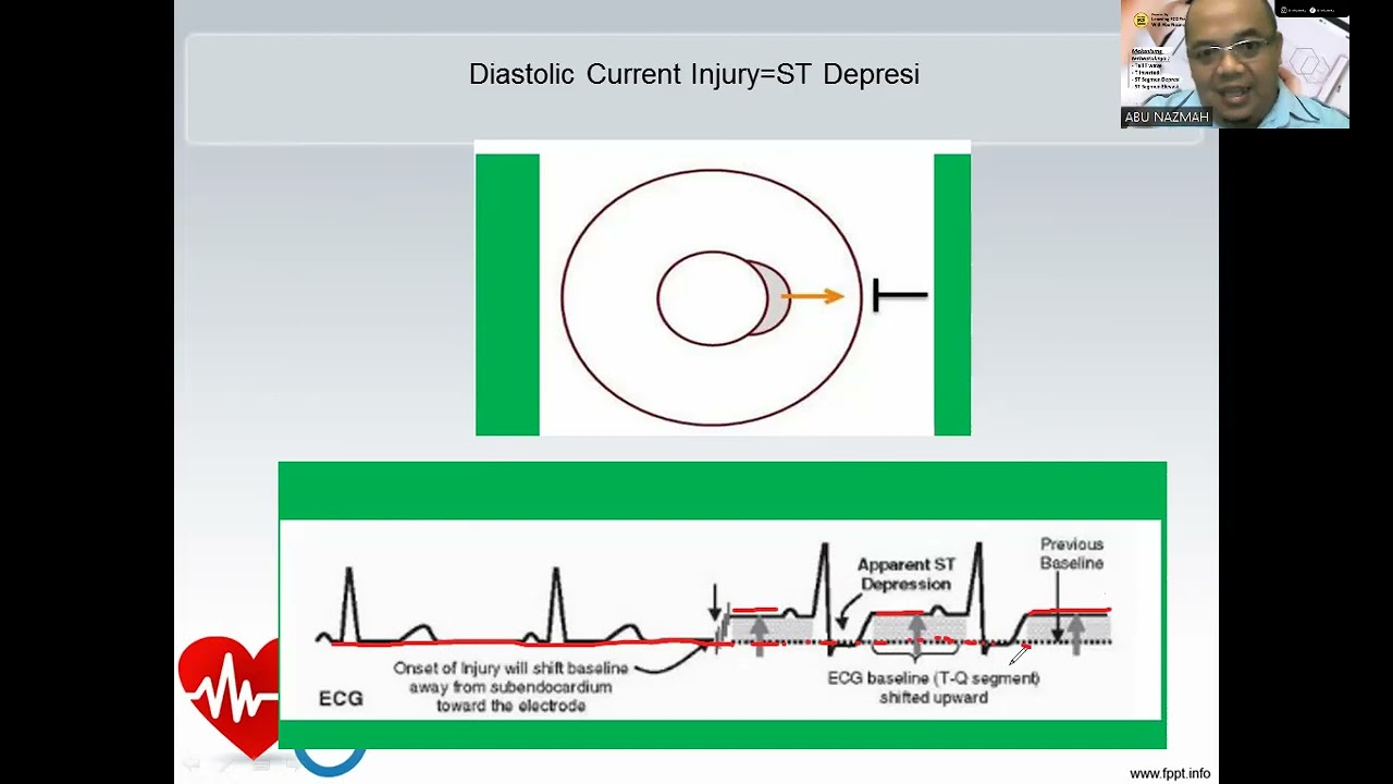 PART-3  Mekanisme Terbentuknya Tall Twave, T Inverted, ST segmen Depresi, ST segmen Elevasi