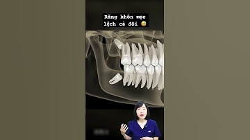 Răng khôn mọc lệch đâm vào răng số 7 | Dr Anh Thư