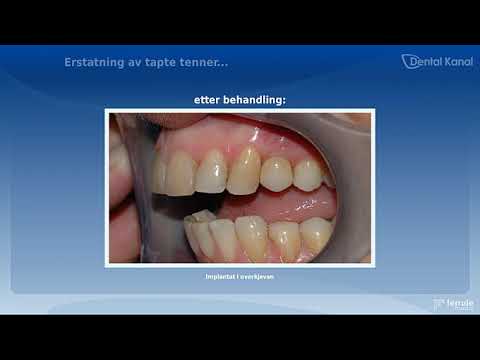 Video: Tannimplantasjon - Typer Implantasjon, Komplikasjoner Og Kontraindikasjoner