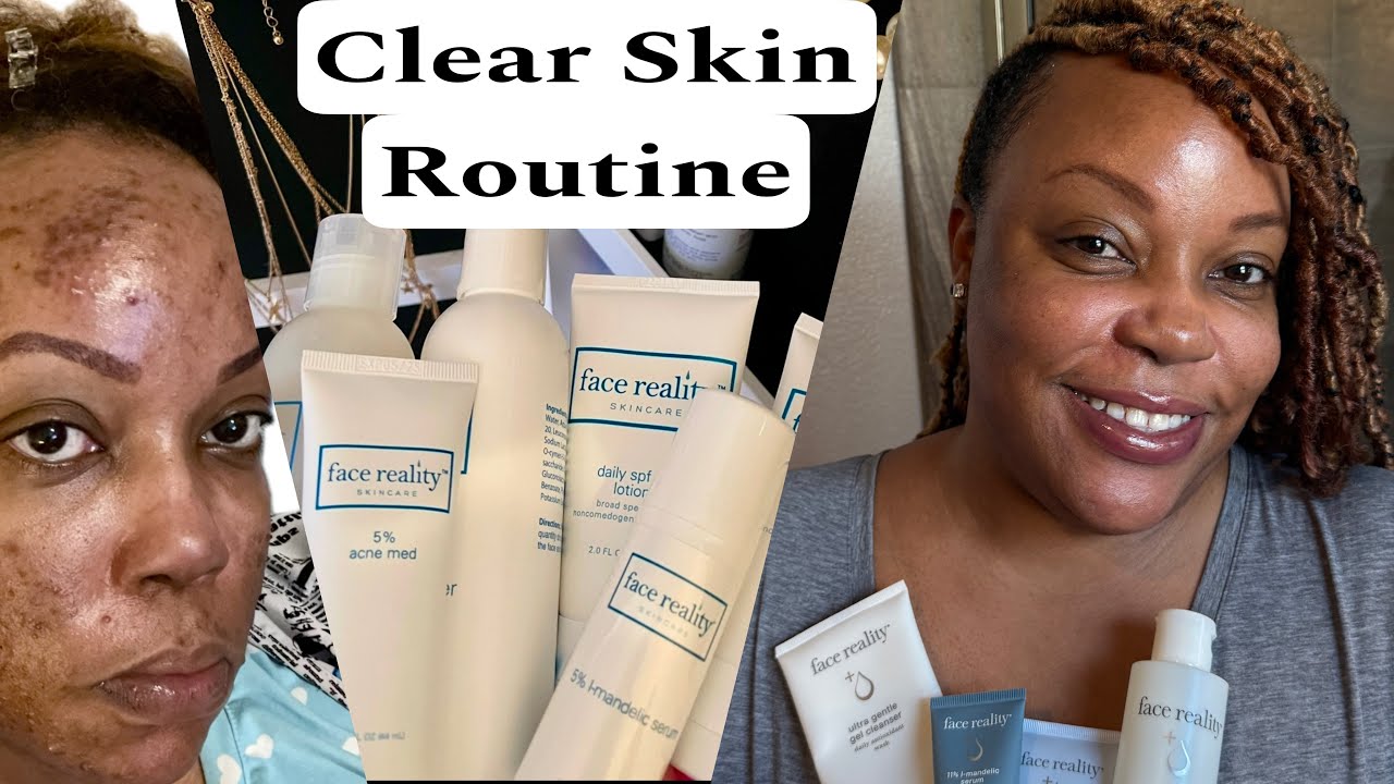 How I Cleared My Acne : My Skincare Routine - YouTube