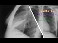 A 72 years old female patient presented with chronic cough | FRCR Radiology RS case 19