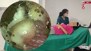采耳哥 | Giant Earwax Blockage | Disturbing but Satisfying Removal #ED456