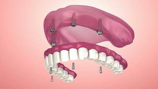 Dental Implant Problems – Everything You Must Know